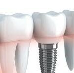 dental implants north york