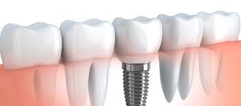 dental implants north york