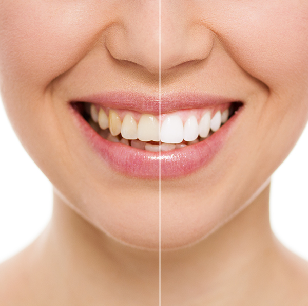 cosmetic-dental-bonding-north-york