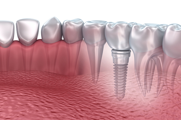 dental-implants