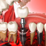 dental-implants-north-york