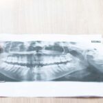 benefits-of-dental-implants-north-york