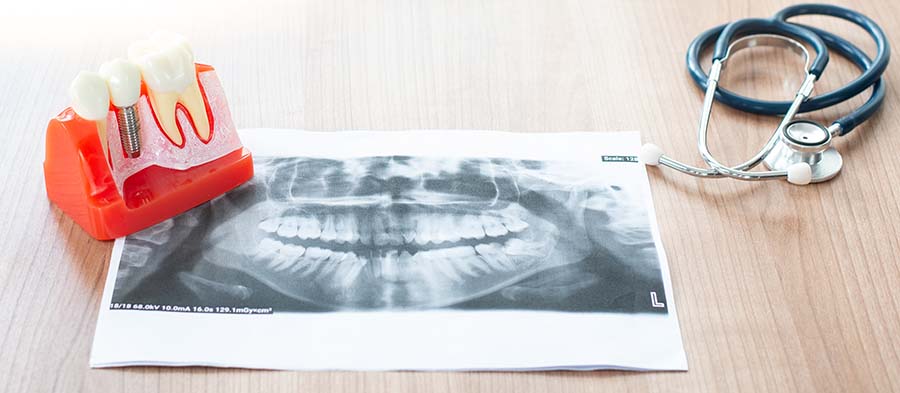 benefits-of-dental-implants-north-york